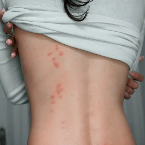 Photo du dos d'une jeune avec des piqûres de punaises de lit regroupées.